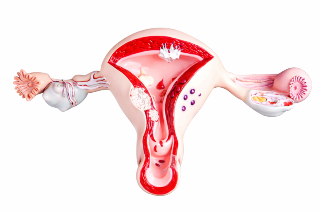 Was ist ein Uterusseptum