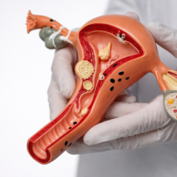 Ablation des Fibromes en Préservant l’Utérus