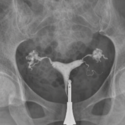 Chirurgie de l’Hydrosalpinx