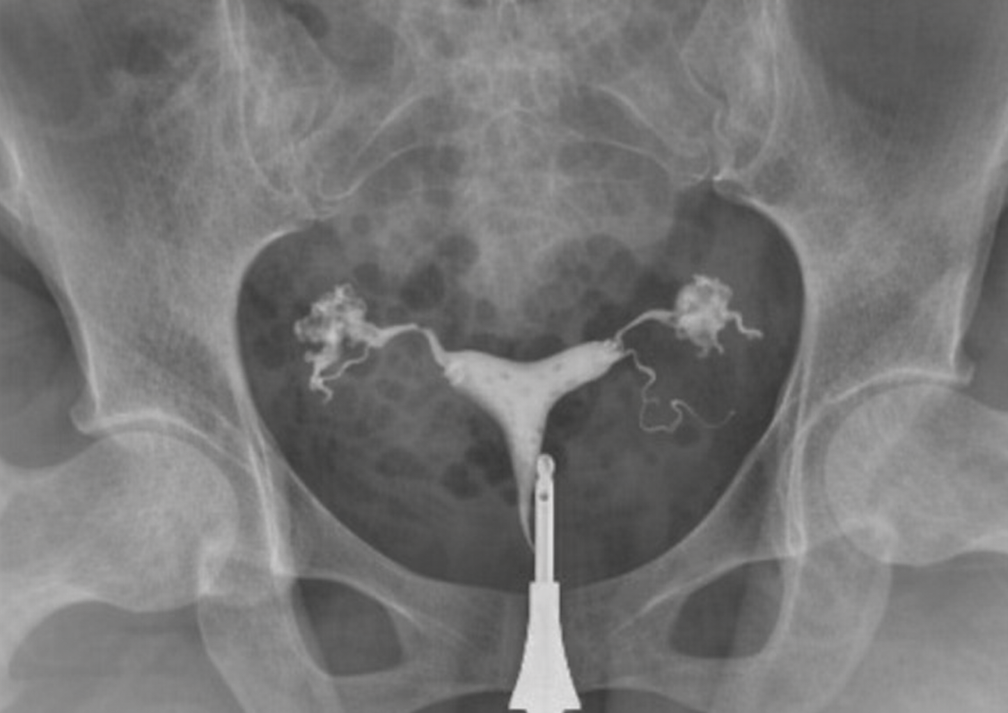 Chirurgie de l’Hydrosalpinx