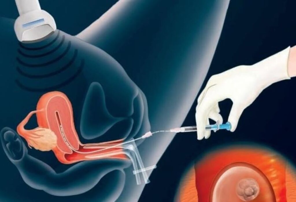 IVF Embryo Transfer Process