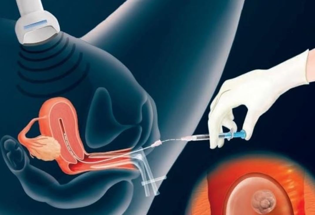 IVF Embryo Transfer Process