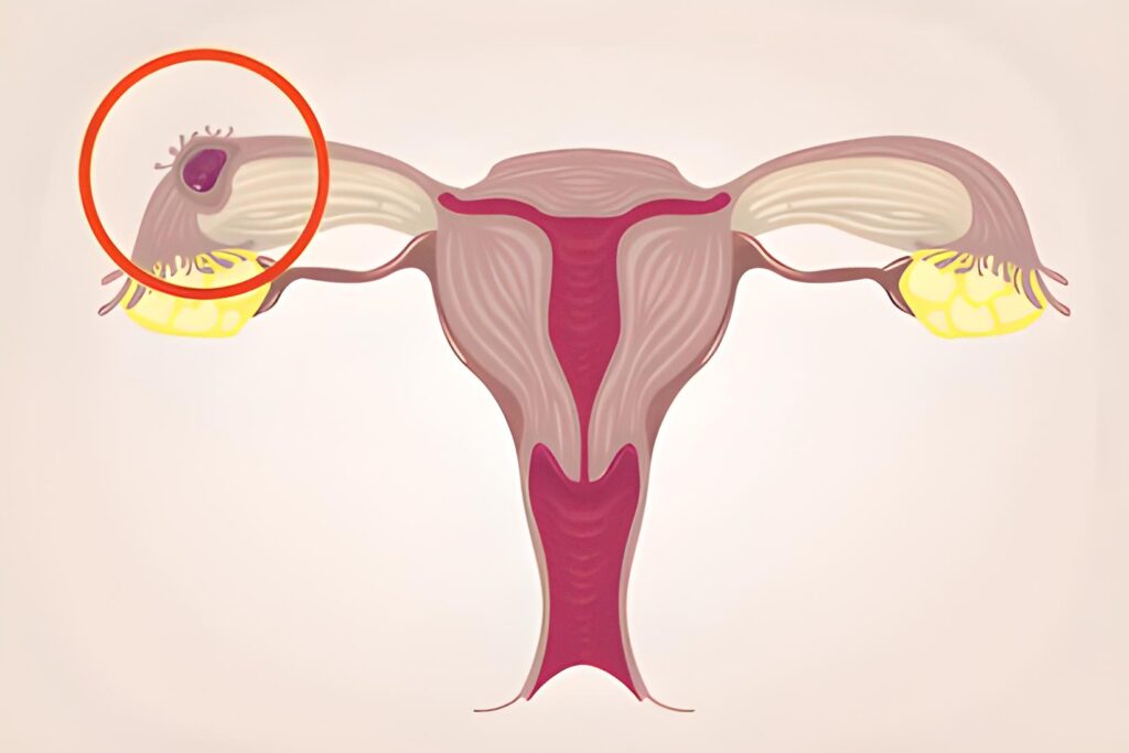 What is the Ectopic Pregnancy